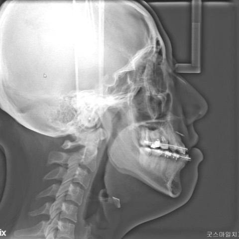 Profile change after double jaws surgery!
#blacks…