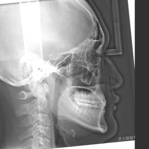 Recovery of inclination of both anterior teeth
#b…