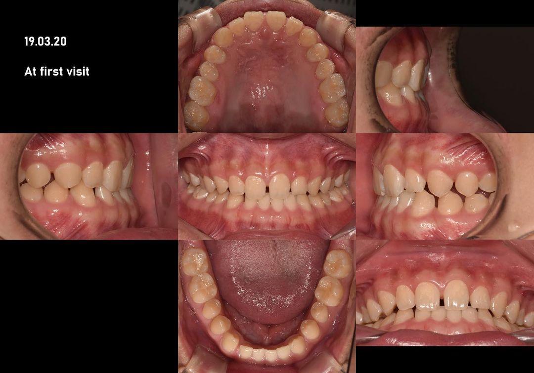 Treatment of generalized spaced dentition with sev…