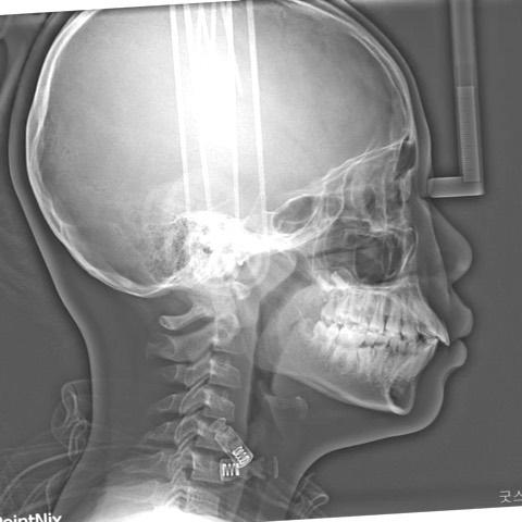 upper total arch intrusive retraction
correction …
