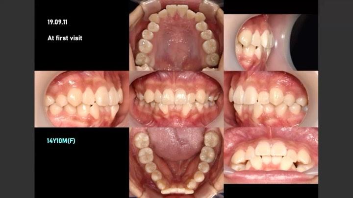 Camouflage treatment of dental Class II with anter…