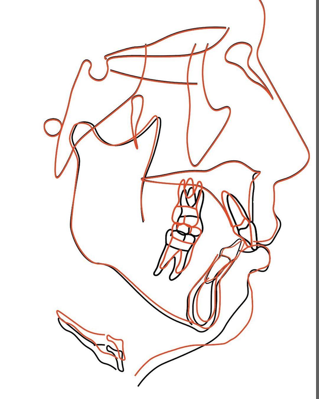 total arch intrusive retraction without extraction…