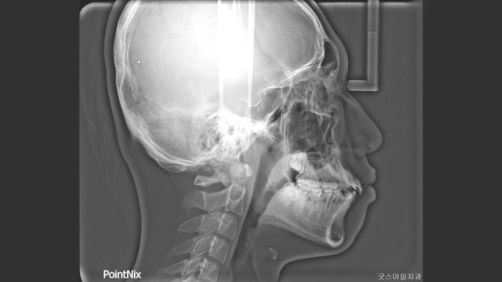 Camouflage treatment of skeletal Class II with hyp…