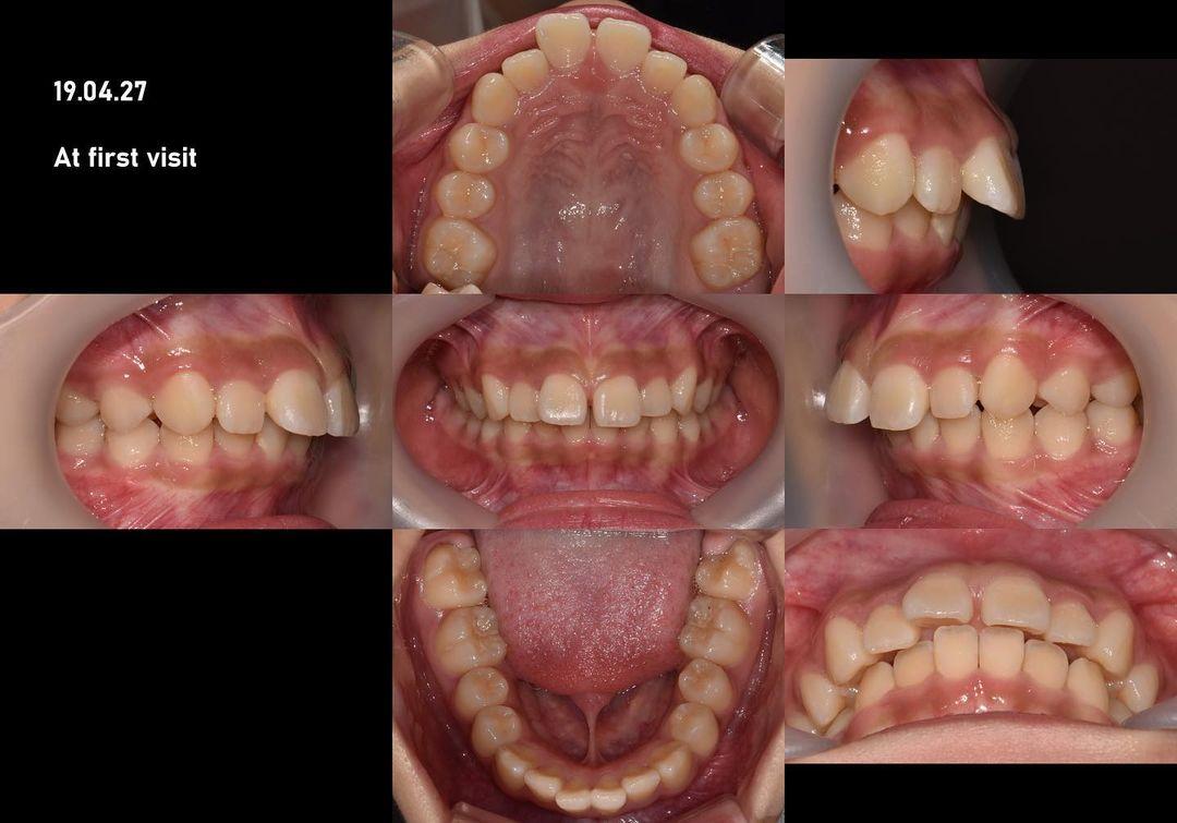 Camouflage treatment of skeletal Class II with ver…
