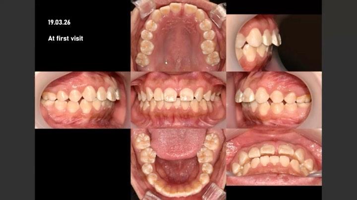 Canine substitution and upper total arch retractio…