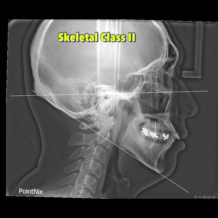 Treatment of skeletal Class II with severe lower a…