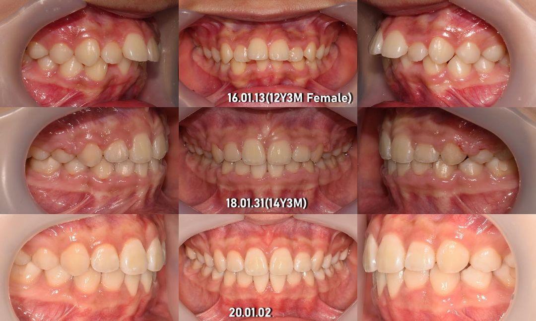 Treatment of lipprotrusion
3 years retention
#bla…