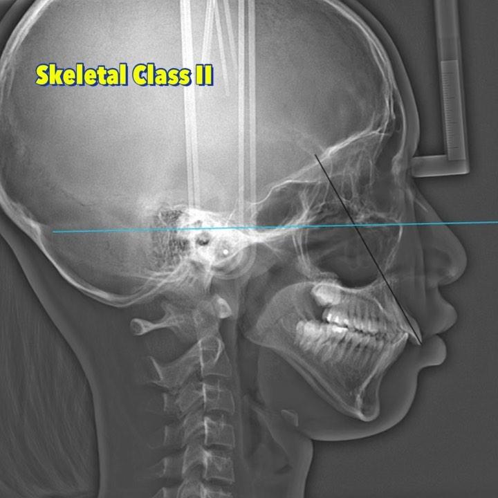Upper total arch intrusive retraction of skeletal …