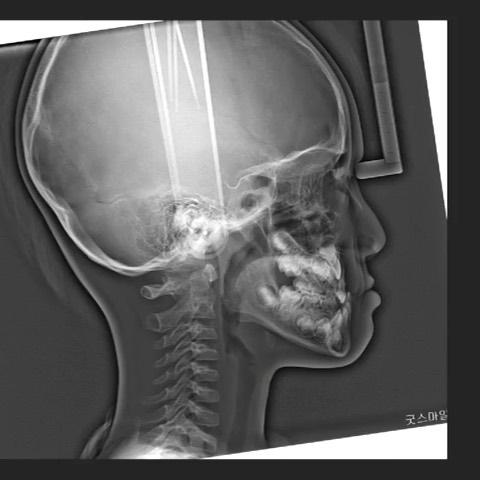Treatment of skeletal Class III with maxillary def…