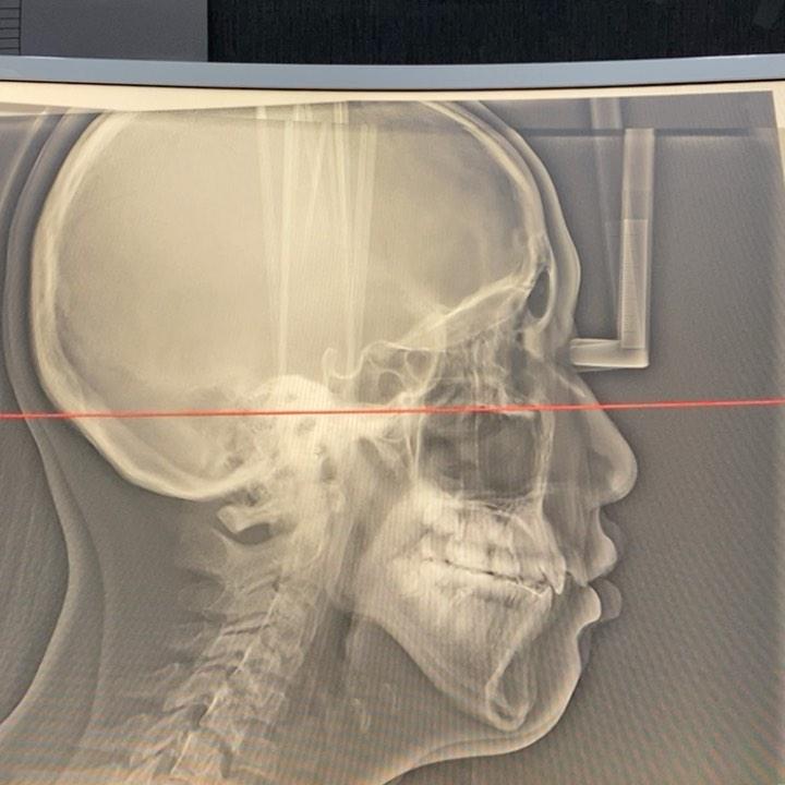 역시 high angle 환자는 어렵나봐ㅜ 내가 그렇게 안자라게 하려고 온 갖 짓을 다했는…