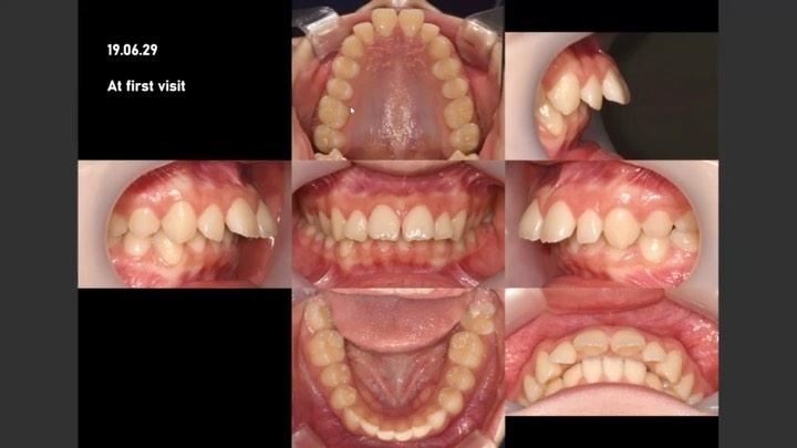 Camouflage treatment of skeletal Class II, dental …
