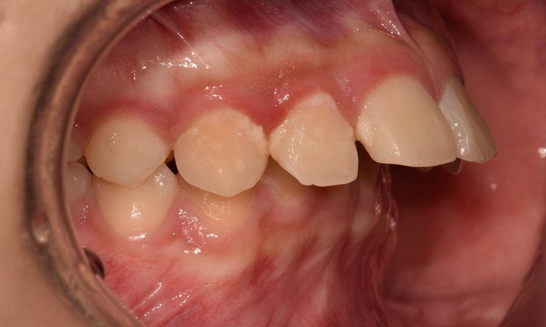 Camouflage treatment of skeletal Class II, dental …