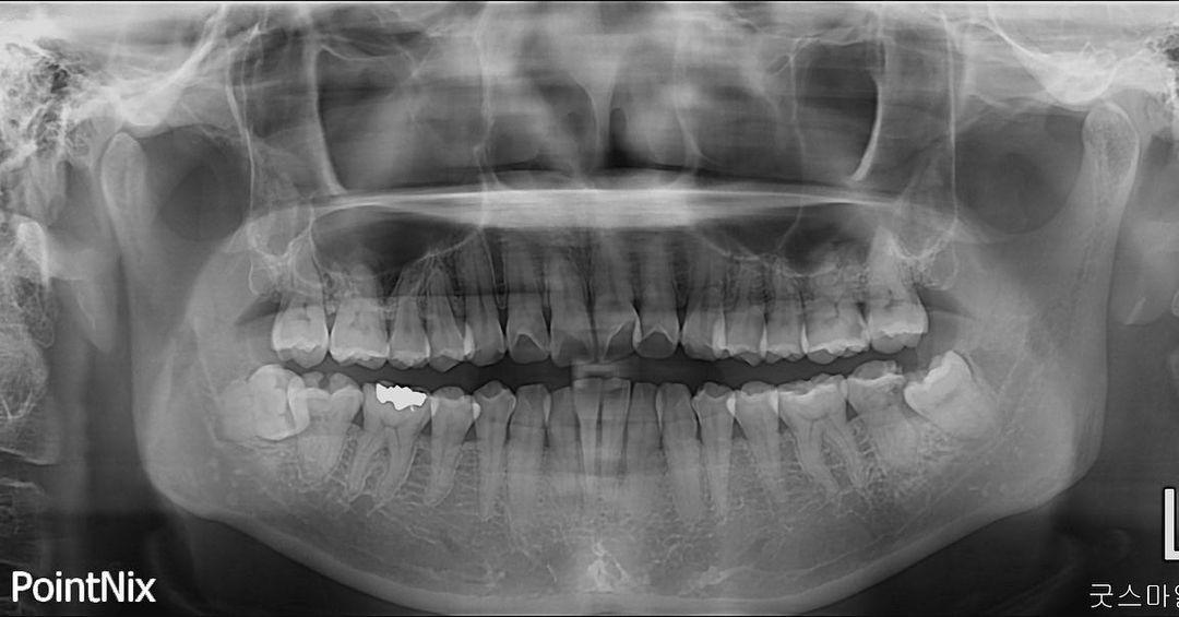 protraction of both lower third molars…