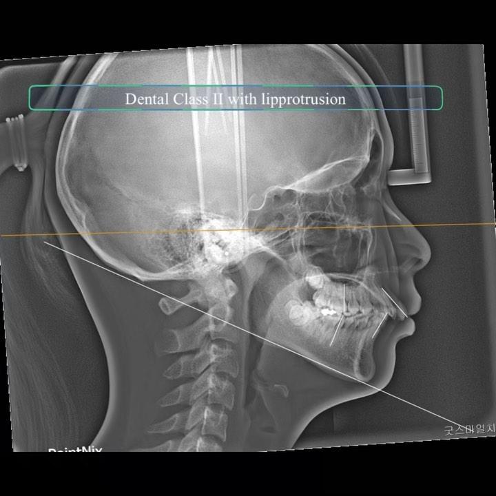 Camouflage treatment of skeletal Class II with lar…