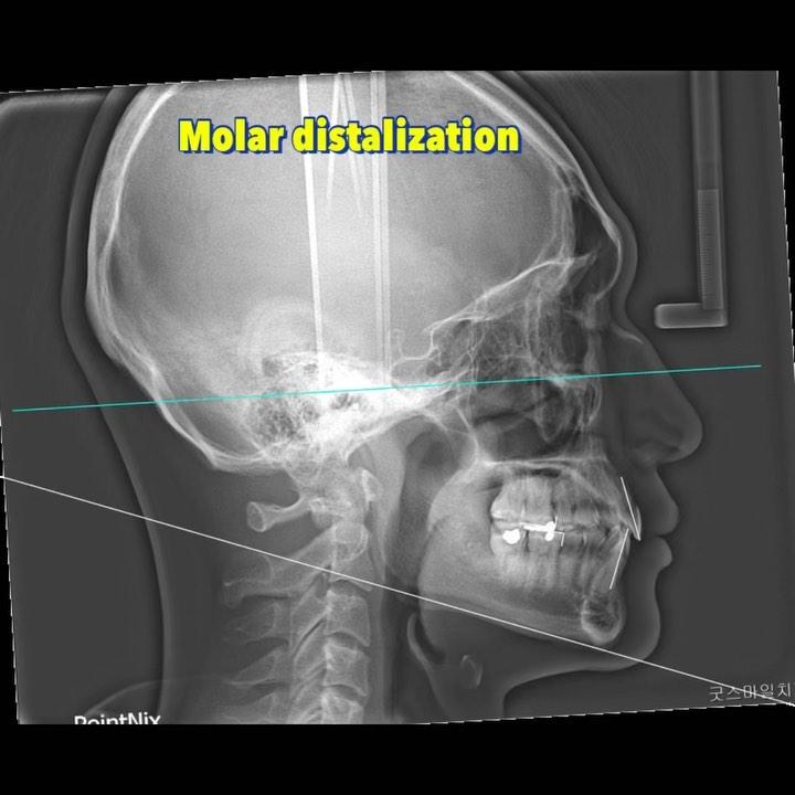 molar distalization to correct moderate to severe …