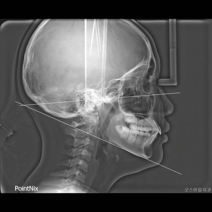 Treatment of skeletal Class II
upper molar dista…