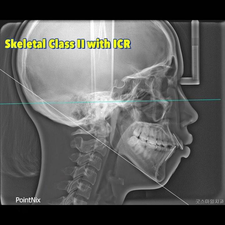 Camouflage treatment of skeletal Class II with ICR…