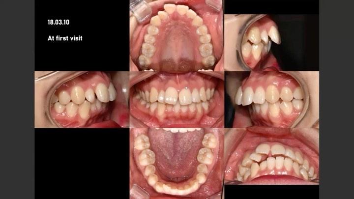 orthodontic treatment of patient with DJD
#blacksh…