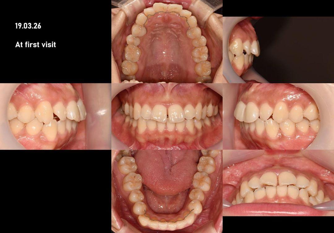 Retreatment of clear aligner case
problems list
1…