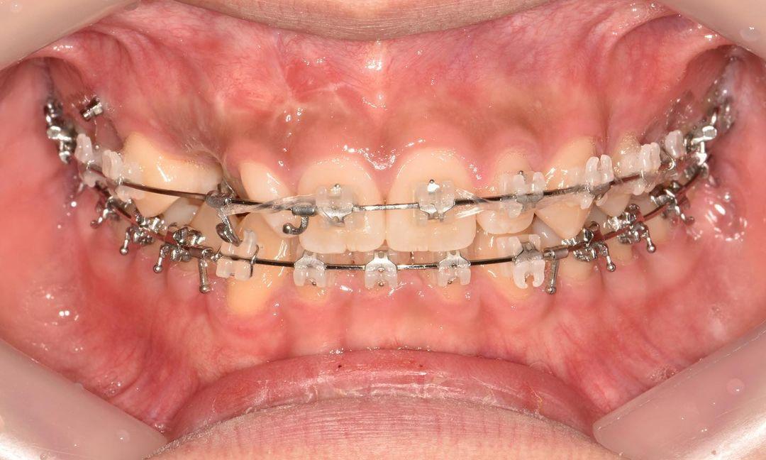 treatment of palatally impacted canine
#blackshaq…