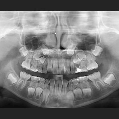 Phase 1 correction of complete transposition betwe…