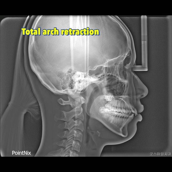 Total arch intrusive retraction of upper arch#bl…