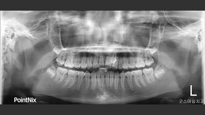 Treatment of complete transposition between canine…