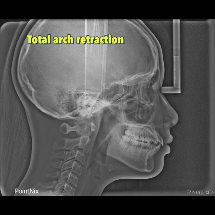 Upper total arch retraction
#blackshaqgoodsmile …
