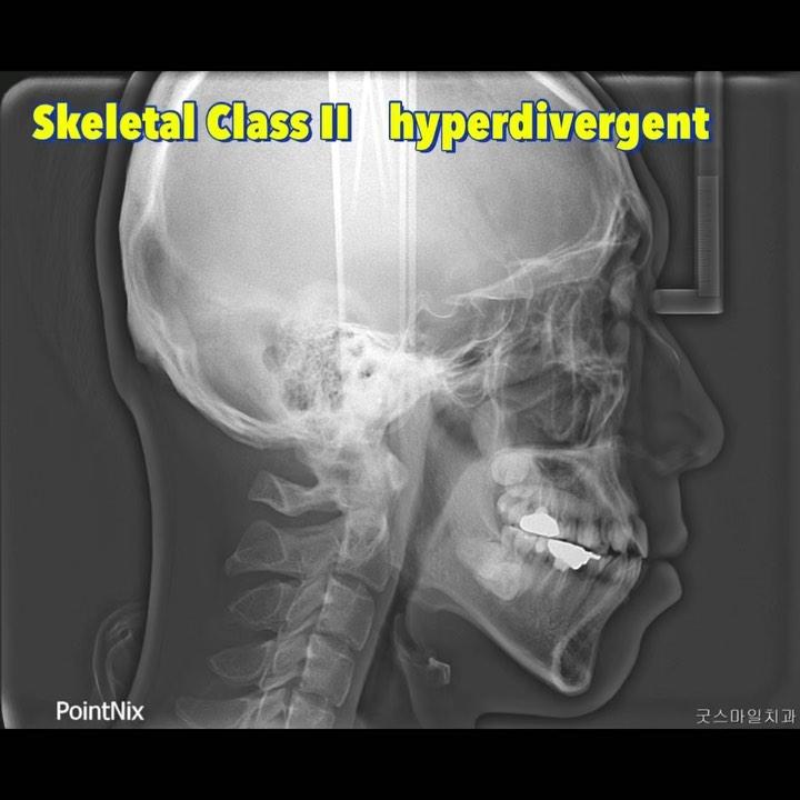 Treatment of skeletal Class II with lipprotrusion …
