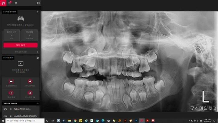 Treatment of complete transposition between canine…