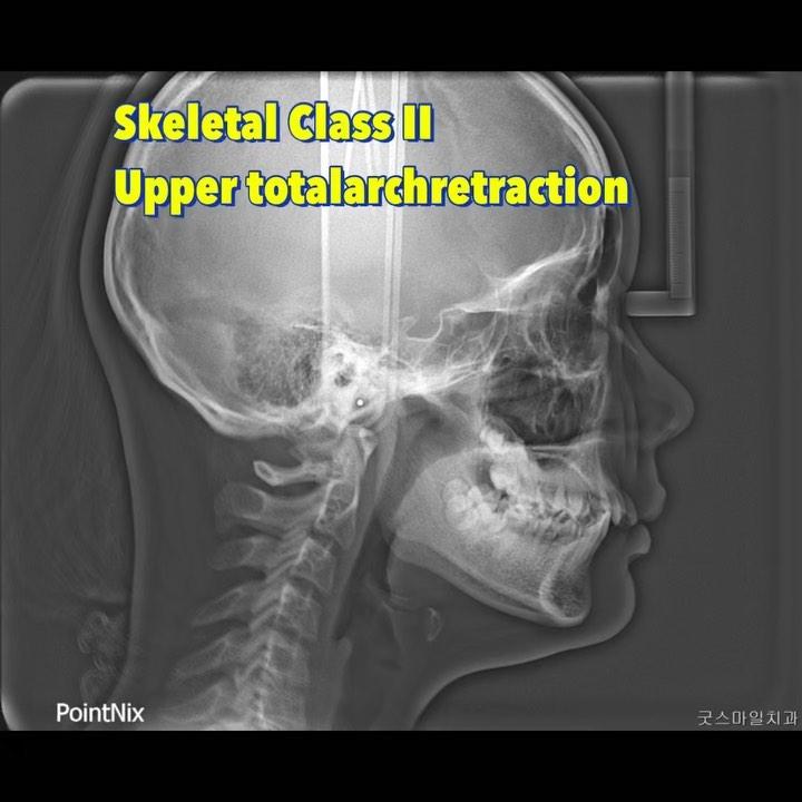 continued
Upper total arch retraction
#blacksh…