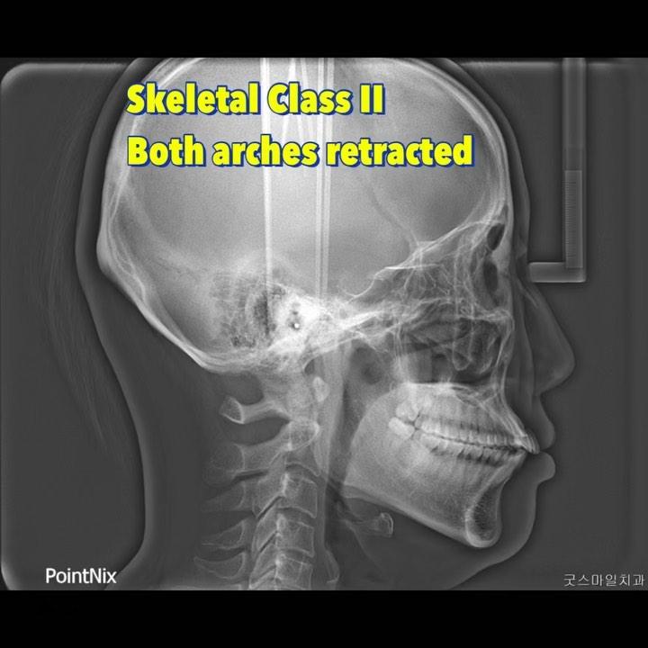 total arch retraction to solve lip protrusion
#b…