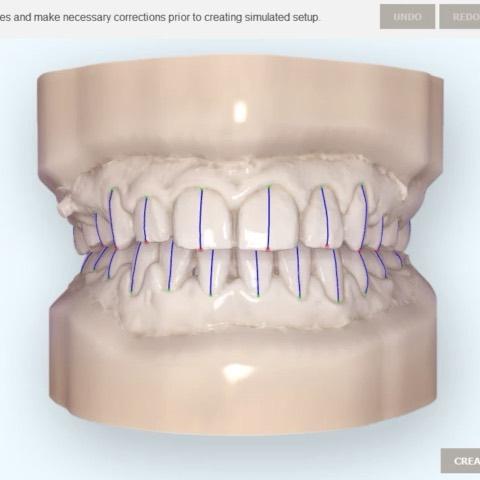 continued
post treatment
#blackshaqgoodsmile…