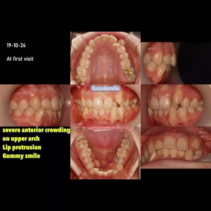 Camouflage treatment of skeletal Class II with upp…