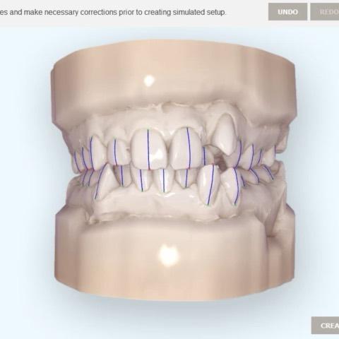 Skeletodental dysplasia
skeletal Class II with sev…