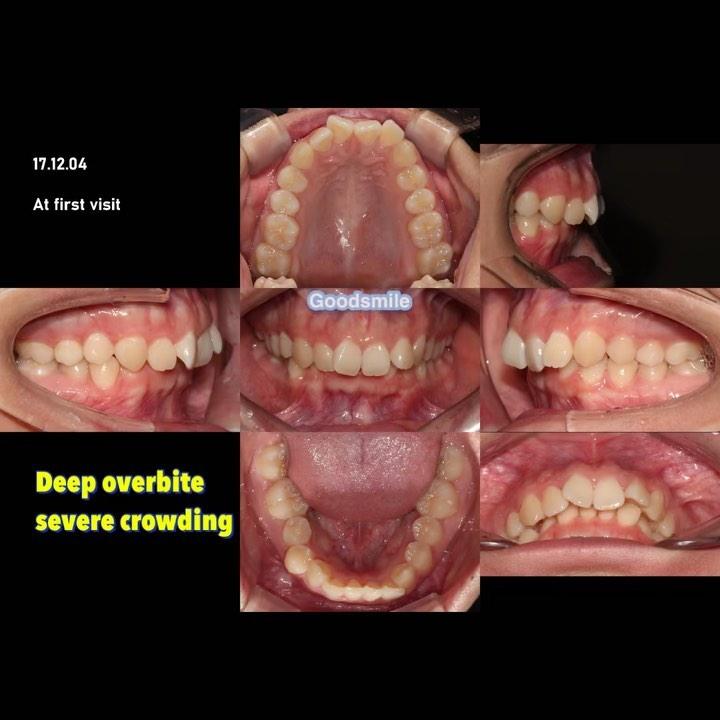 Correction of Class II, division 2 with deep overb…