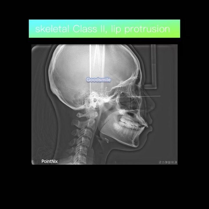 Skeletal Class II with lip-protrusion
#blackshaqg…