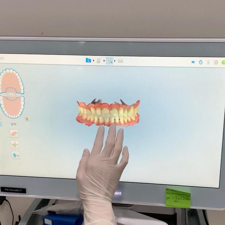 Treatment of upper left canine and 1st premolar co…