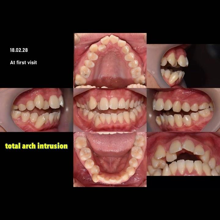 Camouflage treatment of skeletal openbite with man…