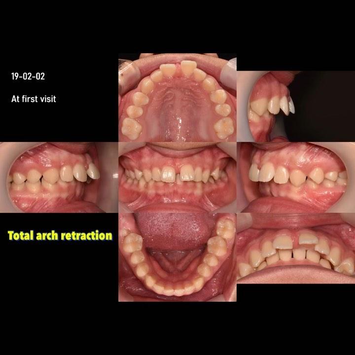 Camouflage treatment of skeletal Class II with den…
