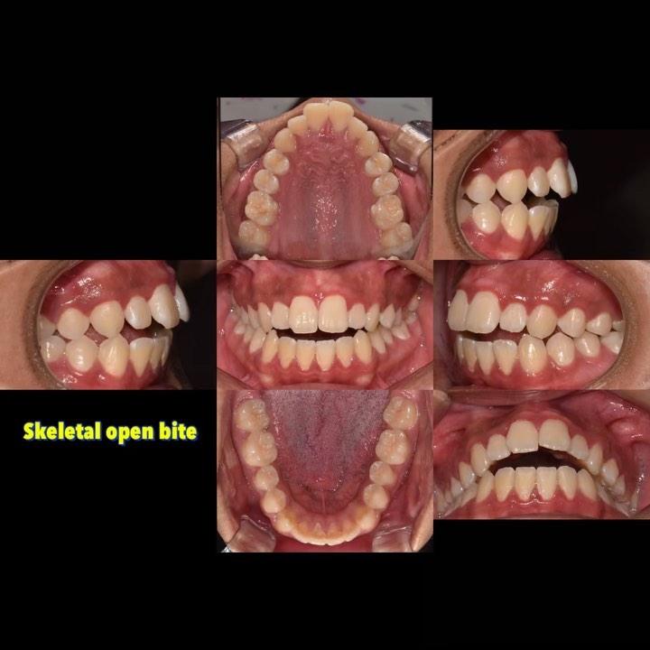 Camouflage treatment of skeletal openbite
#black…