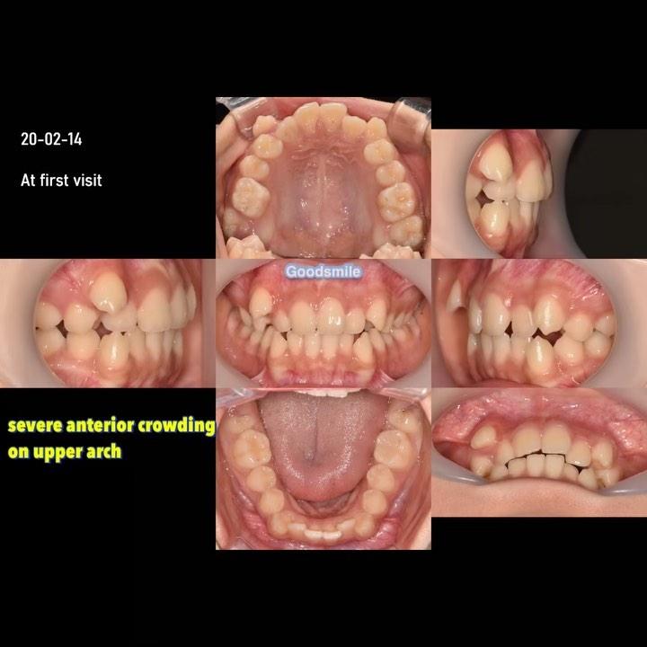 Camouflage treatment of skeletal Class I, dental C…
