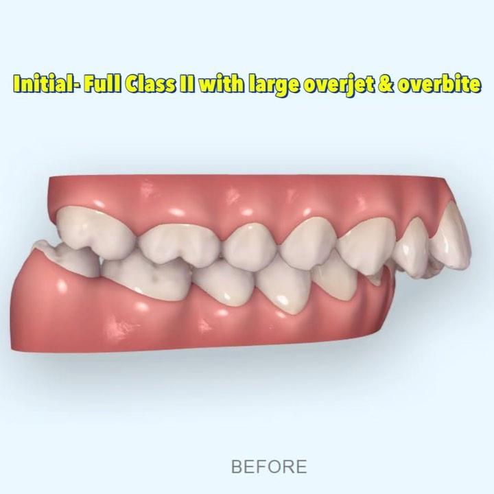 Camouflage treatment of skeletal Class II, dental …