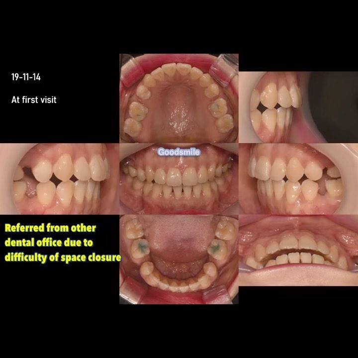 Retreatment of dental Class II with open bite & re…