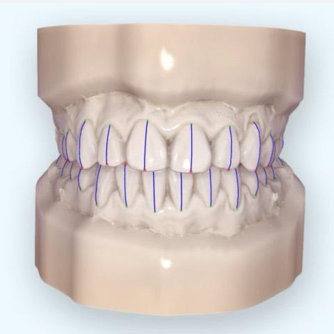 total arch distalization
#blackshaqgoodsmile…