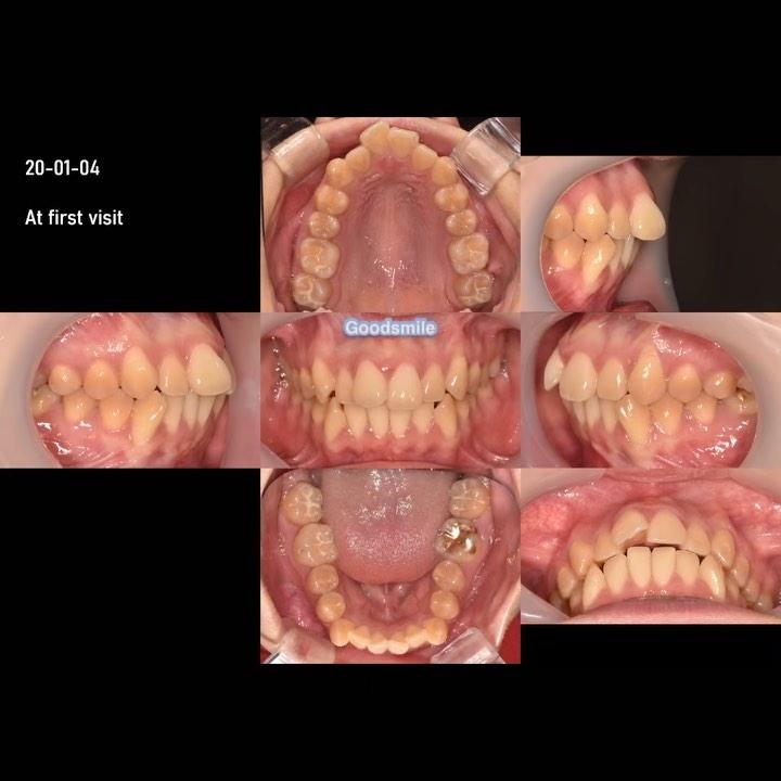 Total arch distalization
#blackshaqgoodsmile #mic…