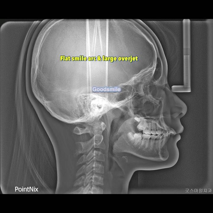 Treatment of skeletal Class II, dental Class II wi…