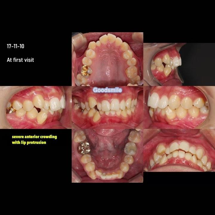 Camouflage treatment of skeletal Class II, mandibu…