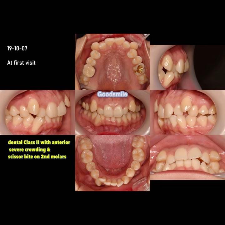 Correction of dental Class II with severe anterior…