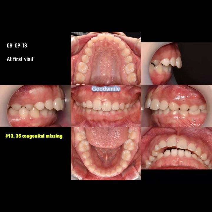 Treatment of skeletal Class II with mandibular asy…